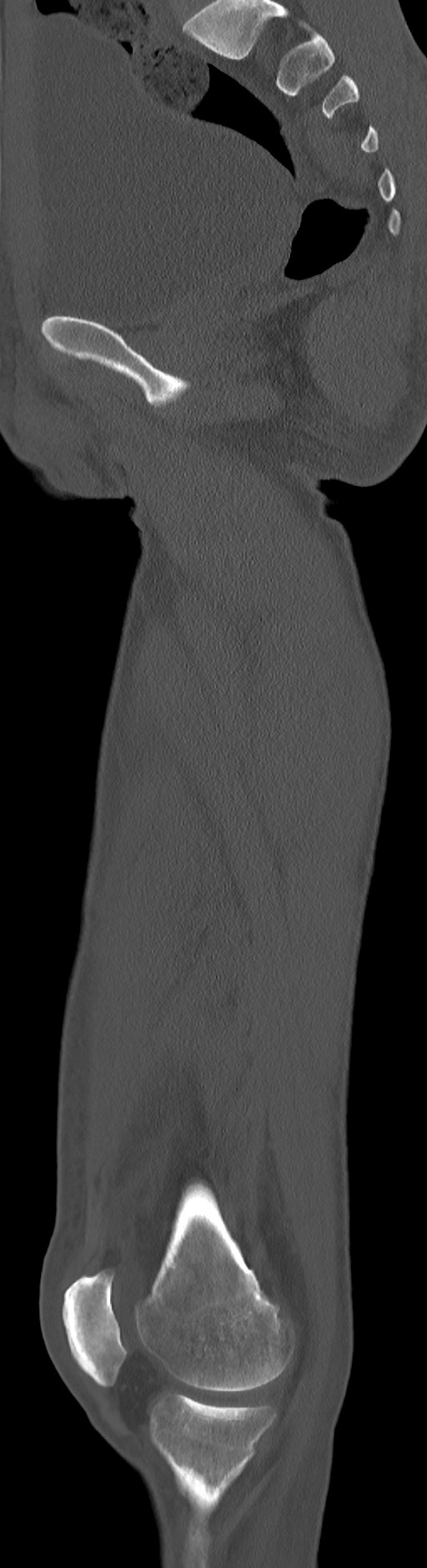 Chronic osteomyelitis (with sequestrum) (Radiopaedia 74813-85822 C 63).jpg