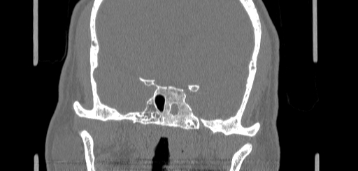 Chronic sphenoidal sinusitis (Radiopaedia 62030-70122 Coronal bone window 128).jpg