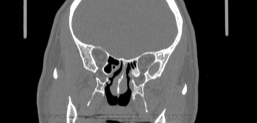 Chronic sphenoidal sinusitis (Radiopaedia 62030-70122 Coronal bone window 94).jpg