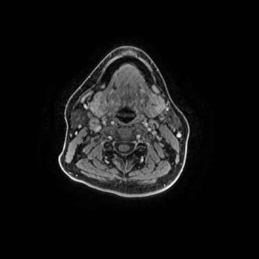 Chronic submandibular sialadenitis (Radiopaedia 61852-69885 Axial T1 C+ fat sat 54).jpg