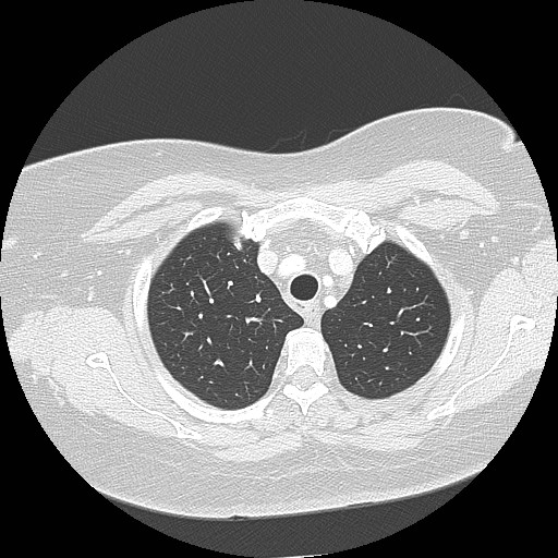 File:Cicatrisation collapse (Radiopaedia 17405-17089 lung window 22).jpg