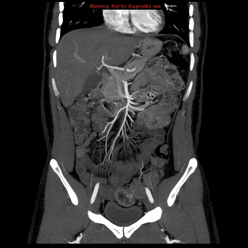 File:Circumaortic left renal vein (Radiopaedia 9069-9792 B 10).jpg