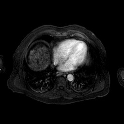Cirrhosis and hepatocellular carcinoma in the setting of hemochromatosis (Radiopaedia 75394-86594 Axial T1 C+ fat sat 164).jpg