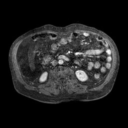 Cirrhosis and hepatocellular carcinoma in the setting of hemochromatosis (Radiopaedia 75394-86594 Axial T1 C+ fat sat 180).jpg