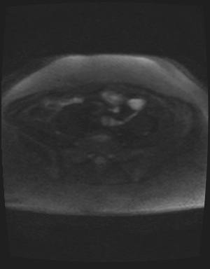 Class II Mullerian duct anomaly- unicornuate uterus with rudimentary horn and non-communicating cavity (Radiopaedia 39441-41755 Axial DWI 67).jpg