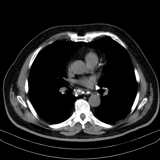 File:Classic complicated silicosis (Radiopaedia 49720-54961 Axial liver window 30).jpg