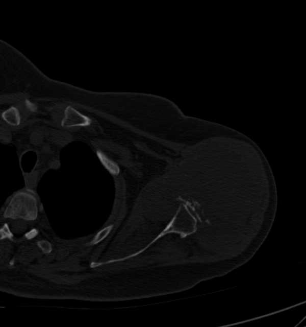 Clear cell chondrosarcoma - humerus (Radiopaedia 63104-71612 Axial bone window 38).jpg