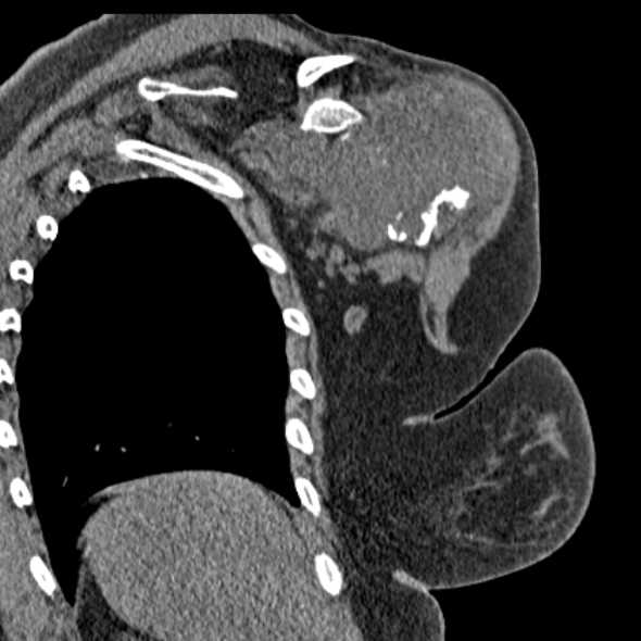 Clear cell chondrosarcoma - humerus (Radiopaedia 63104-71612 Coronal non-contrast 40).jpg