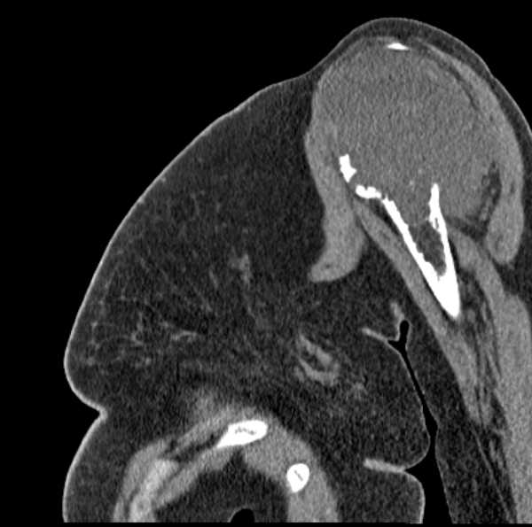 Clear cell chondrosarcoma - humerus (Radiopaedia 63104-71612 D 22).jpg