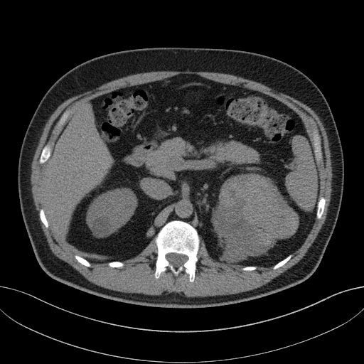 File:Clear cell renal cell carcinoma (Radiopaedia 61449-69393 Axial non-contrast 23).jpg