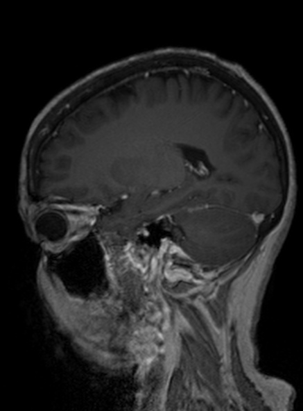 File:Clival meningioma (Radiopaedia 53278-59248 Sagittal T1 C+ 303).jpg