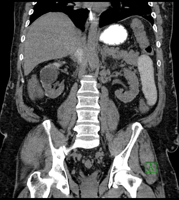 Closed-loop small bowel obstruction-internal hernia (Radiopaedia 78439-91096 Coronal non-contrast 64).jpg