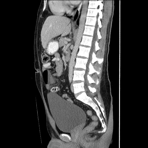 File:Closed-loop small bowel obstruction (Radiopaedia 73713-84509 B 89).jpg