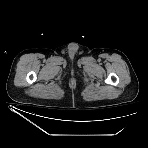 File:Closed loop obstruction due to adhesive band, resulting in small bowel ischemia and resection (Radiopaedia 83835-99023 Axial non-contrast 178).jpg