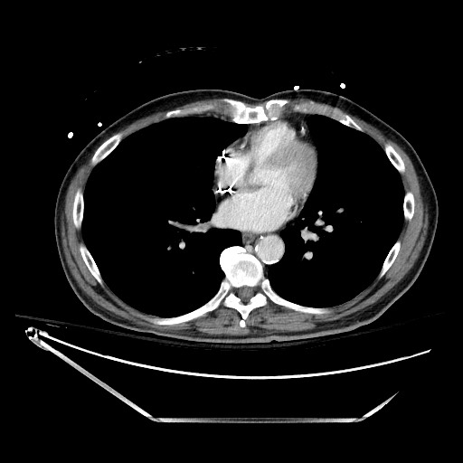 Closed loop obstruction due to adhesive band, resulting in small bowel ischemia and resection (Radiopaedia 83835-99023 D 4).jpg