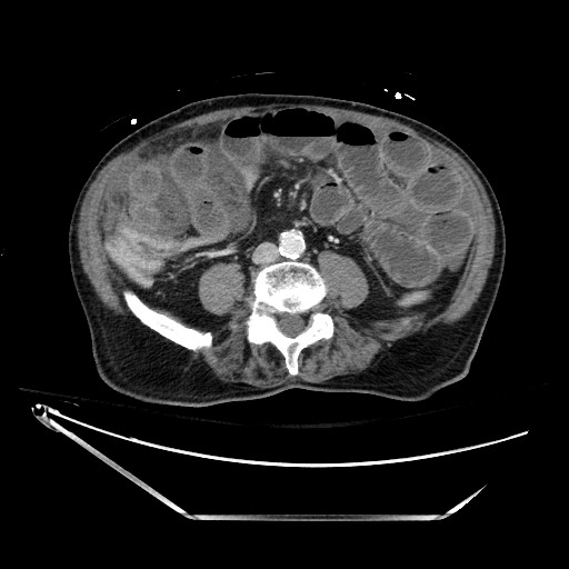 Closed loop obstruction due to adhesive band, resulting in small bowel ischemia and resection (Radiopaedia 83835-99023 D 92).jpg