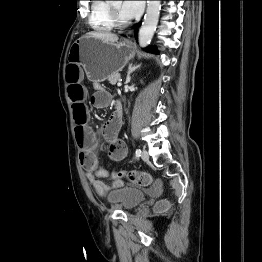 Closed loop obstruction due to adhesive band, resulting in small bowel ischemia and resection (Radiopaedia 83835-99023 F 111).jpg