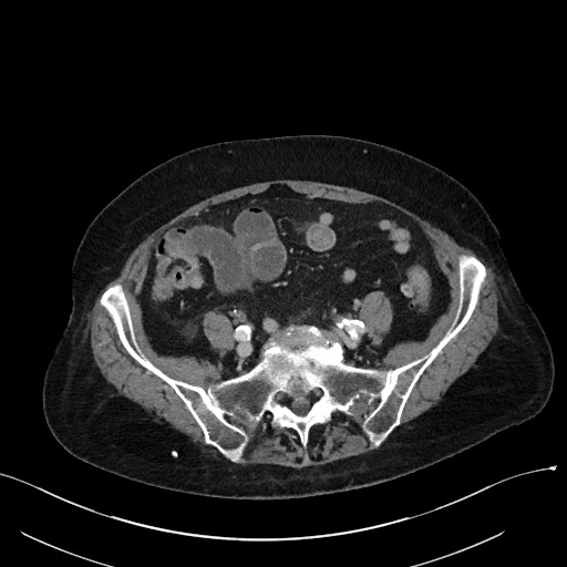 Closed loop small bowel obstruction - adhesions (Radiopaedia 59269-66611 A 93).jpg