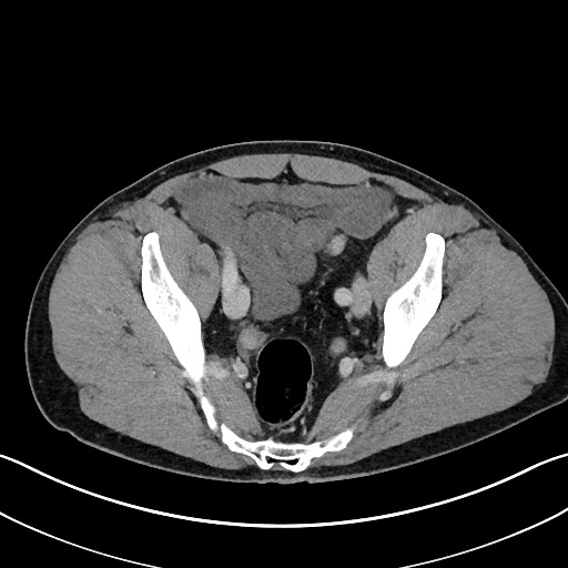 Closed loop small bowel obstruction - internal hernia (Radiopaedia 57806-64778 B 106).jpg