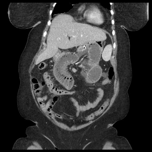 Closed loop small bowel obstruction - internal hernia (Radiopaedia 65402-74450 B 33).jpg