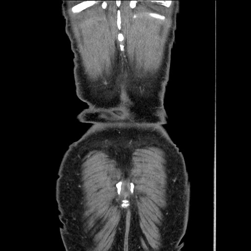 Closed loop small bowel obstruction - omental adhesion causing "internal hernia" (Radiopaedia 85129-100682 B 122).jpg