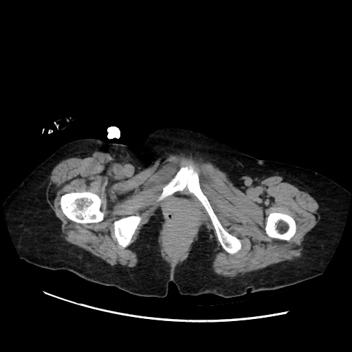 File:Closed loop small bowel obstruction due to adhesive band, with intramural hemorrhage and ischemia (Radiopaedia 83831-99017 Axial non-contrast 167).jpg