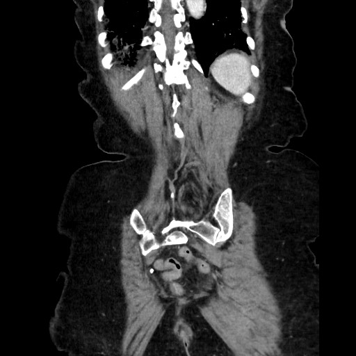 File:Closed loop small bowel obstruction due to adhesive band, with intramural hemorrhage and ischemia (Radiopaedia 83831-99017 C 105).jpg