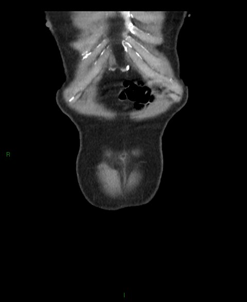 Closed loop small bowel obstruction with ischemia (Radiopaedia 84180-99456 B 65).jpg