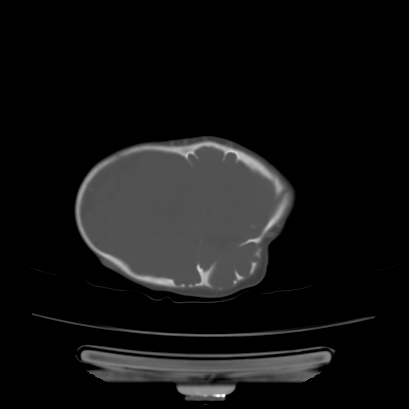 Cloverleaf skull (Radiopaedia 91901-109710 Axial bone window 123).jpg