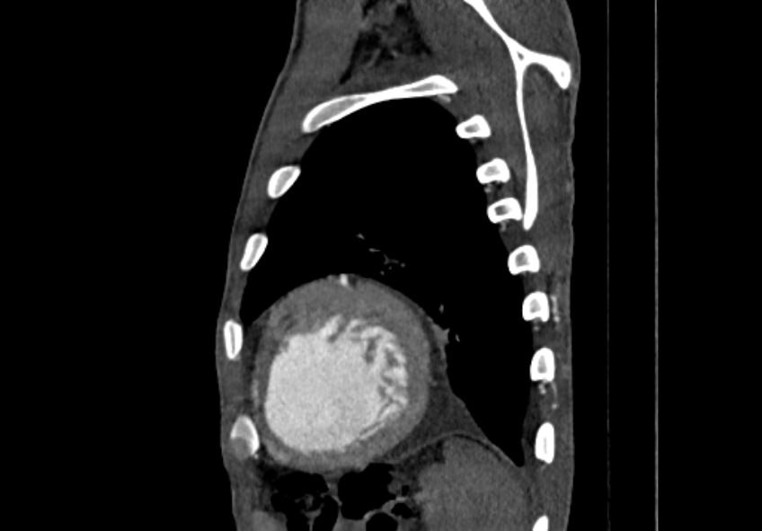Coarctation of aorta with aortic valve stenosis (Radiopaedia 70463-80574 B 204).jpg