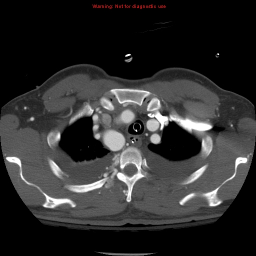 File:Coarctation of the aorta (Radiopaedia 8681-9490 B 15).jpg