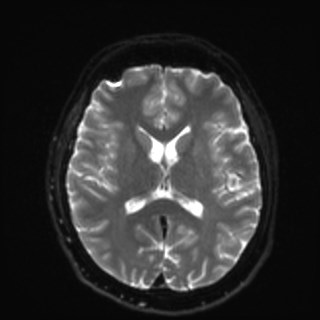 Cochlear incomplete partition type III associated with hypothalamic hamartoma (Radiopaedia 88756-105498 Axial DWI 23).jpg