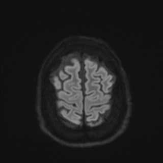 Cochlear incomplete partition type III associated with hypothalamic hamartoma (Radiopaedia 88756-105498 Axial DWI 77).jpg