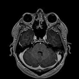 Cochlear incomplete partition type III associated with hypothalamic hamartoma (Radiopaedia 88756-105498 Axial T1 C+ 67).jpg