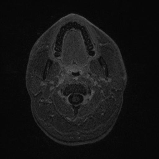 Colloid cyst (Radiopaedia 44510-48181 Axial T1 C+ 4).png