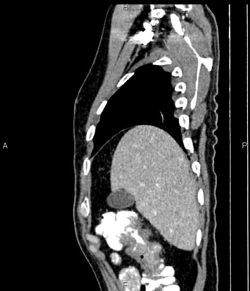 Colon adenocarcinoma (Radiopaedia 83266-97671 D 19).jpg