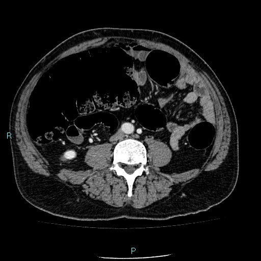 Colon adenocarcinoma with calcific liver metastasis (Radiopaedia 55745-62300 B 26).jpg
