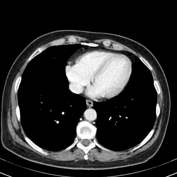 Colon carcinoma with hepatic metastases (Radiopaedia 29477-29961 A 3).jpg