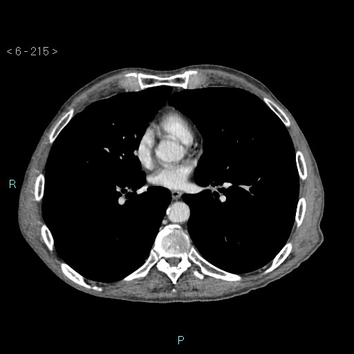 Colonic cancer (ultrasound and TC imaging) (Radiopaedia 50346-55713 B 215).jpg