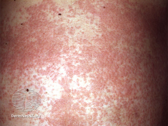 File:Disseminated secondary eczema (DermNet NZ dermatitis-a-ecz1).jpg