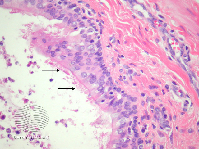 File:Figure 3 (DermNet NZ pathology-e-bronchogenic-cyst-figure-3).jpg