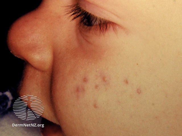 File:Infantile acne (DermNet NZ acne-infantile-acne6).jpg