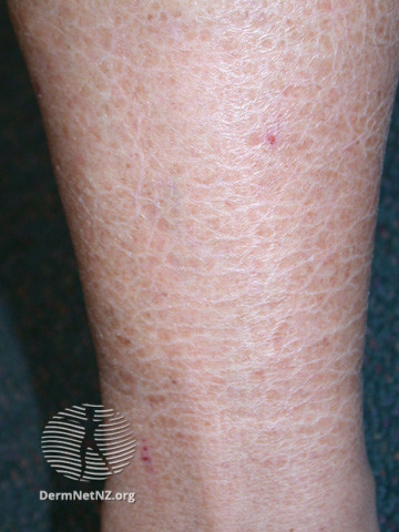 File:Kava ichthyosis (DermNet NZ scaly-ichthyosis2).jpg