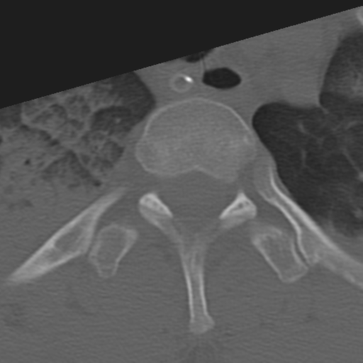 File:Multitrauma with diffuse axonal injury, temporal bone fractures and traumatic caroticocavernous fistula (Radiopaedia 37242-39035 Axial 228).png