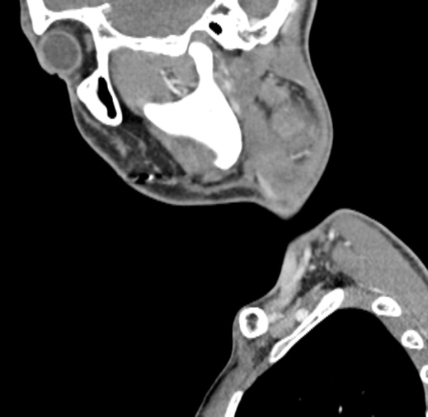 Nasopharyngeal carcinoma with skull base invasion (Radiopaedia 53415-59705 C 60).jpg