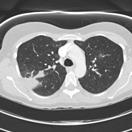 File:Necrobiotic pulmonary nodules - Crohn disease (Radiopaedia 20723-20631 Axial lung window 46).jpg