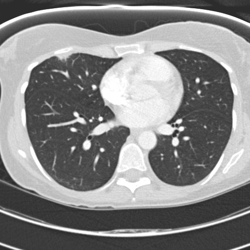 File:Necrobiotic pulmonary nodules - Crohn disease (Radiopaedia 20723-20631 Axial lung window 83).jpg