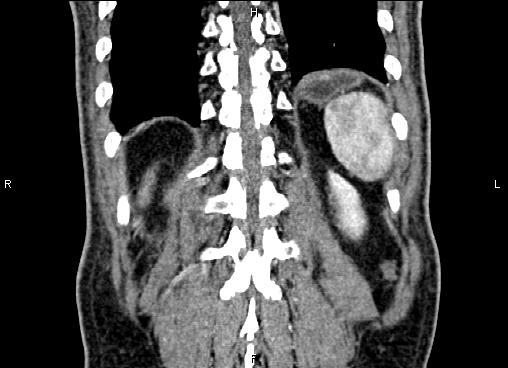 Necrotizing pancreatitis (Radiopaedia 87796-104248 F 58).jpg