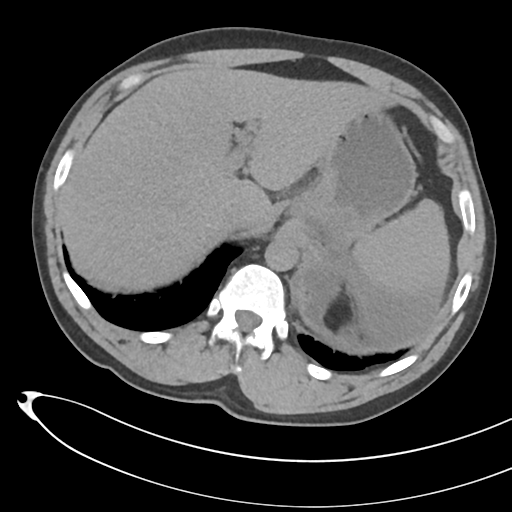 File:Necrotizing pancreatitis with acute necrotic collections (Radiopaedia 38829-41012 Axial non-contrast 18).png