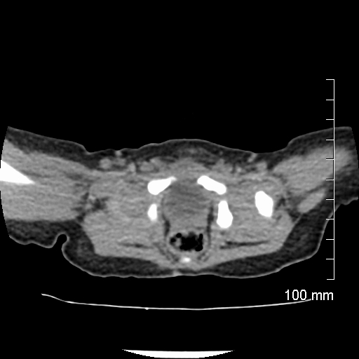 File:Neonatal neuroblastoma (Radiopaedia 56651-63438 Axial non-contrast 77).jpg